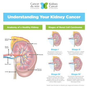 Understanding your kidney cancer Understanding your kidney cancer