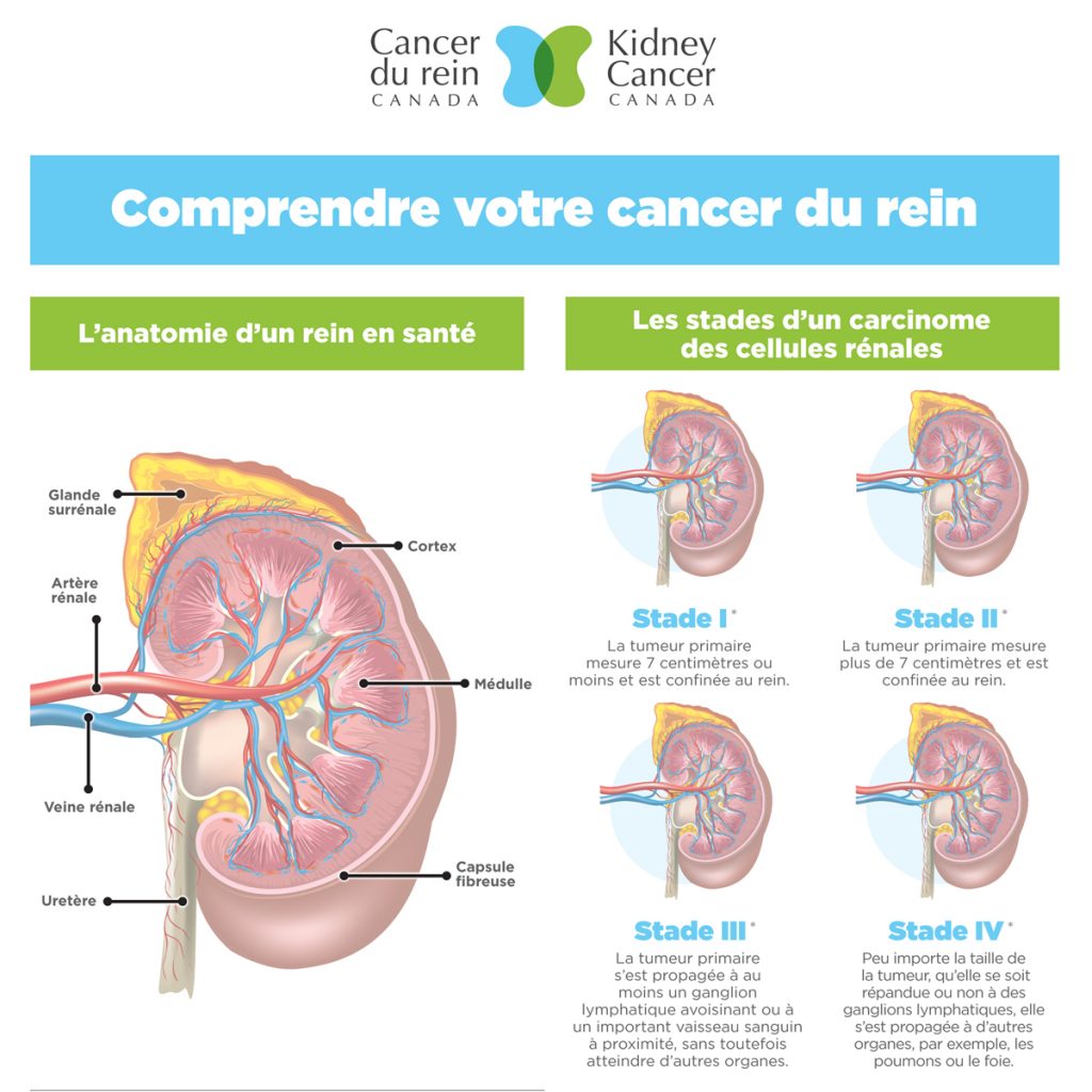 Comprendre votre cancer du rein Comprendre votre cancer du rein